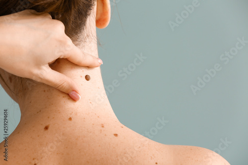 Dermatologist examining moles of patient on grey background photo