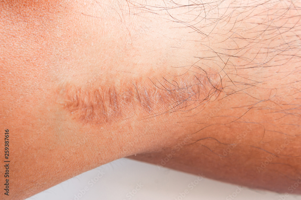 Fototapeta premium a scar or scars on skin.