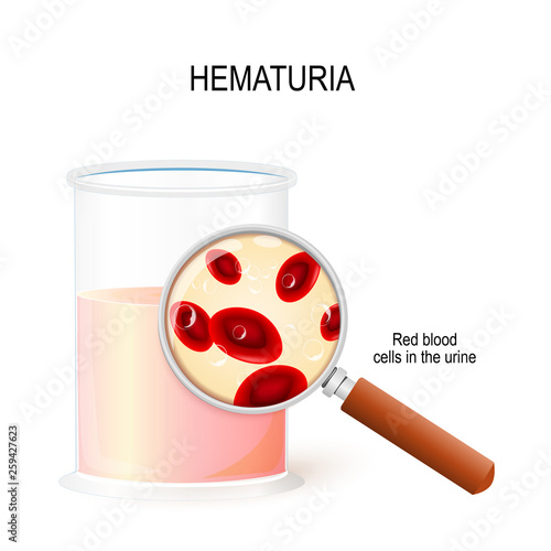 Hematuria. magnifying glass and beaker with urine. Closeup of Red blood cells