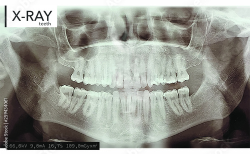 Xray teeth mouth dental tomography. Vector X-ray radiology oral panorama. Medical skeleton x ray background. 