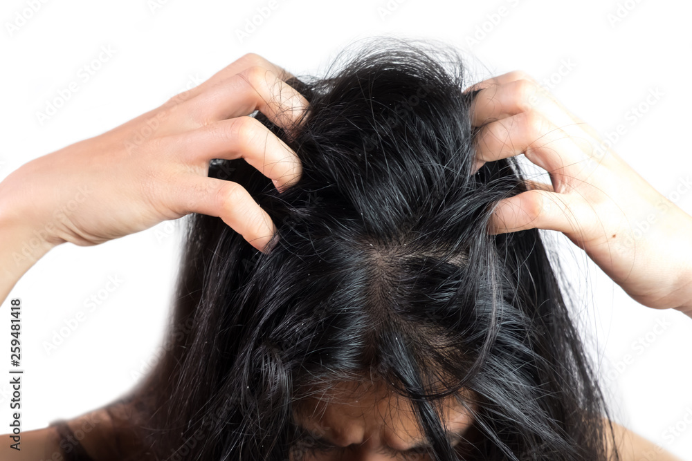 women head with dandruff Caused by the problem of dirty. Or caused by skin disease or Seborrheic Dermatitis. It has white scaly and it will cause itch. women head with dandruff Caused by the problem of dirty. Or caused by skin disease or Seborrheic Dermatitis. It has white scaly and it will cause itch.