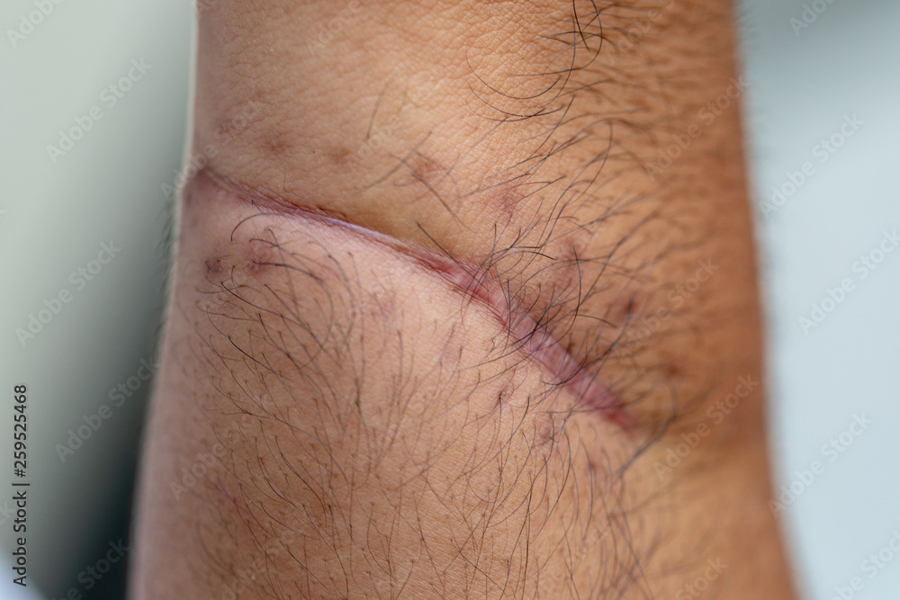 Naklejka premium A scar is an area of fibrous tissue that replaces normal skin after an injury on skin. 