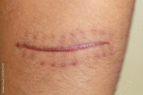 Obraz na plátně A scar is an area of fibrous tissue that replaces normal skin after an injury on skin