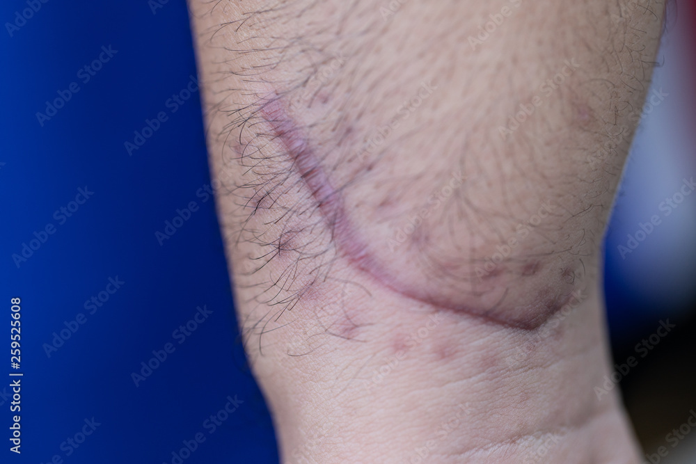 Fototapeta premium A scar is an area of fibrous tissue that replaces normal skin after an injury on skin. 