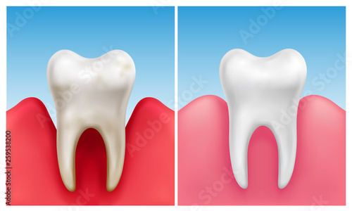 Vector illustration of gum disease -  periodontitis in compare with healthy white tooth