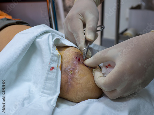 Doctor suturing for repair the amputation wound in patient who have diabetic disease.