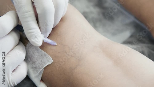Close-up hands of phlebologist in gloves does procedure of sclerotherapy on leg of patient photo