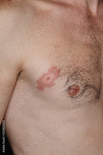 Lyme disease, or Lyme borreliosis, is a bacterial infection spread to humans by infected ticks. The rash is often described as looking like a bull's-eye on a dart board. Erythema migrans (ER).