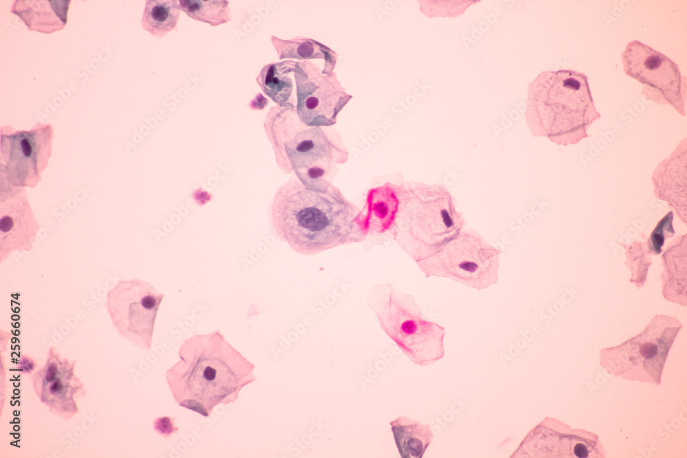 Abnormal squamous epithelial cells view in microscopy.HPV criteria for pap smear slide cytology.Koilocyte cells.Medical background.600 X magnification