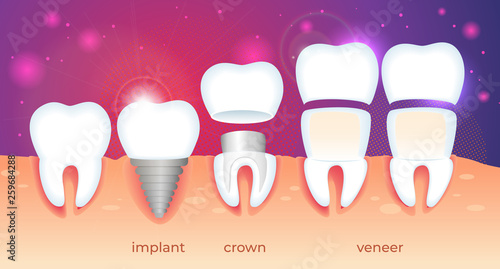 Orthodontic Restoration. Implant, Crown, Veneer.