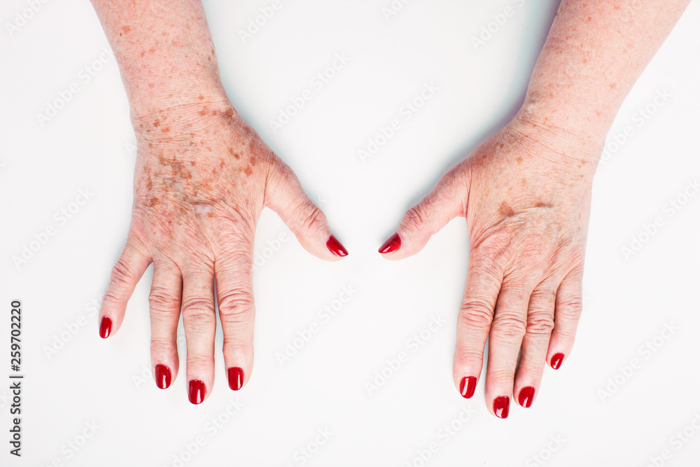 Flabby Arms In Wrinkles And Age Spots Stock Photo Adobe Stock Flabby Arms In Wrinkles And Age Spots Stock Photo Adobe Stock