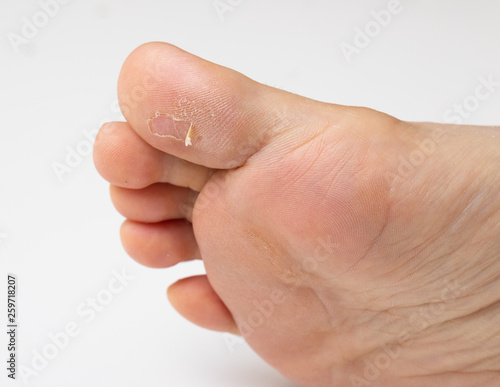 Closeup view of dry and peeling skin on a big toe