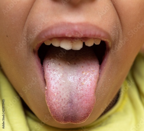 Close-up view of a young child with small spots on the tongue photo