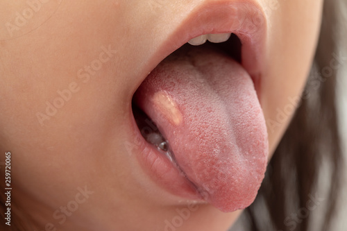 Obraz na plátně Close-up view of a little girl opening her mouth to show an ulcer on the tongue