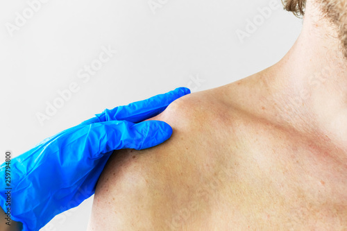 Dislocation or fracture of the clavicle and acromial process with displacement. The doctor examines the patient with a dislocation and fracture of the clavicle and acromial process, close-up photo