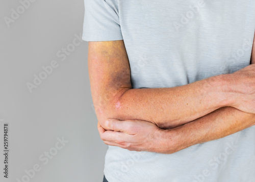 A man in a gray t-shirt on a gray background holds his hand with a fracture or injury. Hand injury with hematomas and bruises