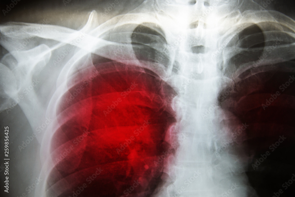 Chest Xray Tuberculosis. Stock Photo Adobe Stock