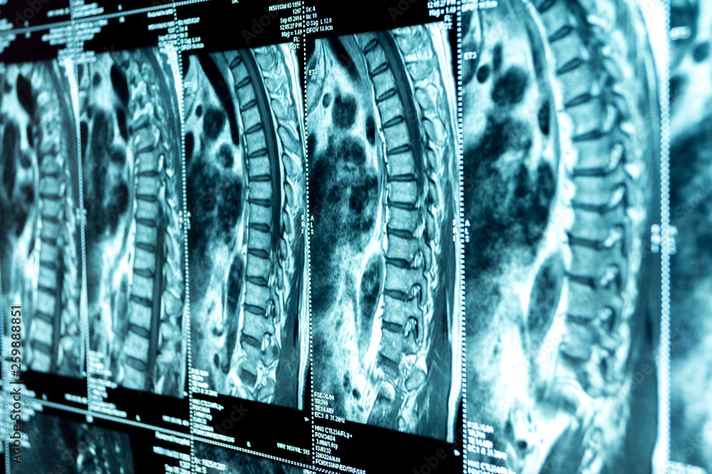 MRI of the thoracic spine Stock Photo | Adobe Stock