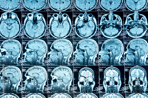 MRI scan of the brain