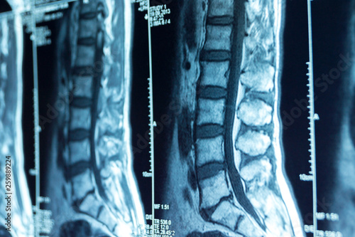 MRI scans of the lumbosacral spine photo