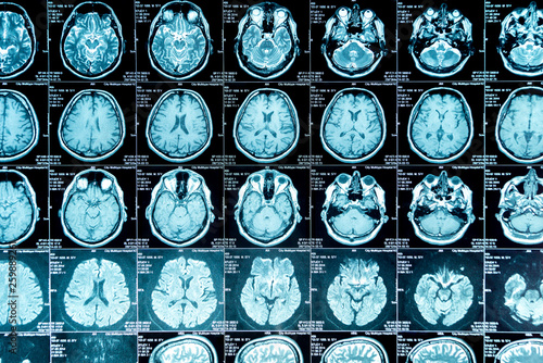 MRI scan of the brain