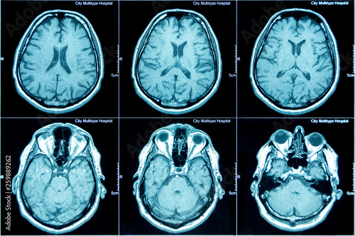 MRI scan of the brain photo
