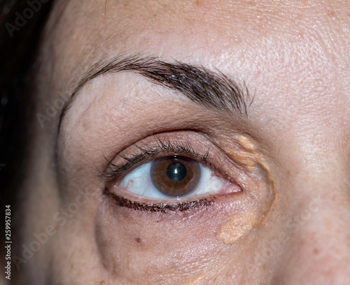 Closeup of woman with xanthelasma photo