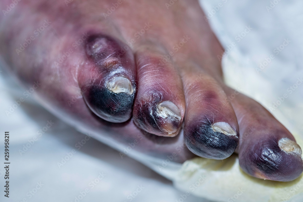 Closeup of foot with gangrene