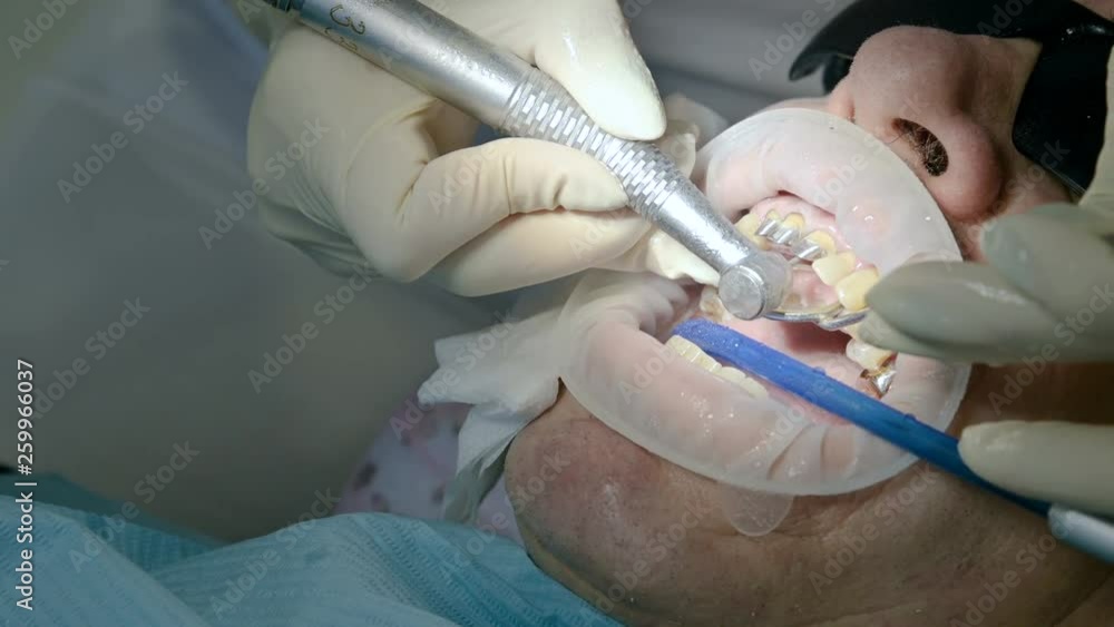 Female dentist with an assistant examines the patient's mouth of a man of an aged man. High key professional work of a dentist in the dental clinic Female dentist with an assistant examines the patient's mouth of a man of an aged man. High key professional work of a dentist in the dental clinic