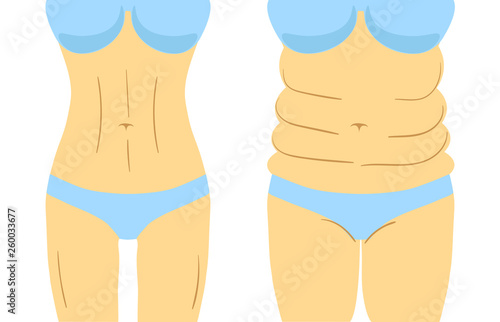 Liposuction before and after effect, fitness or diet. Vector illustration of woman figure