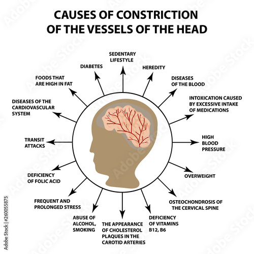Causes of narrowing of cerebral vessels. World Stroke Day. Infographics. Vector illustration on isolated background