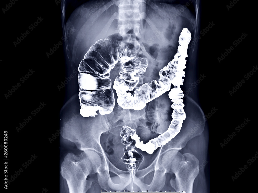 barium enema image or xray image of large intestine AP view showing
