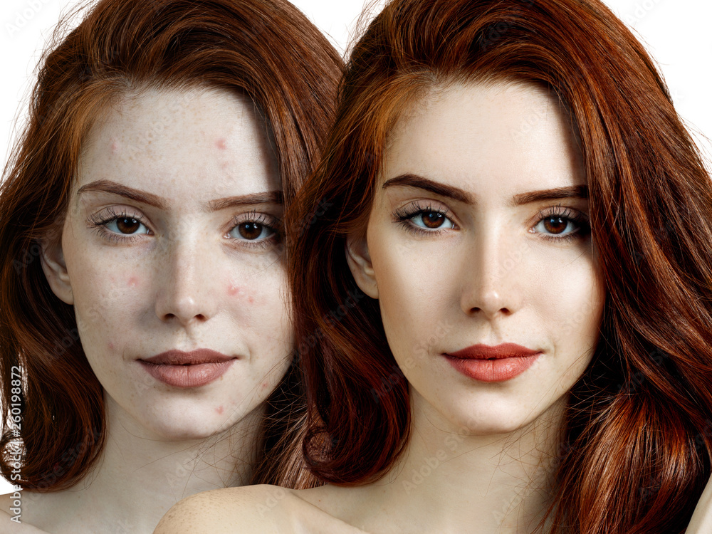 Young woman before and after skin treatment and makeup.