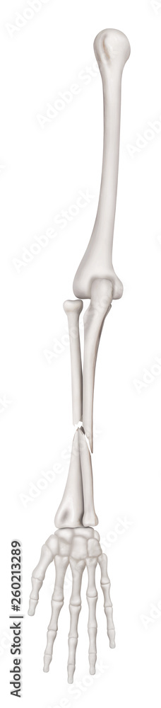 Ulna and Radius Fractures or Broken Arms completed displaced fracture type anterior view-3D Medical and Biomedical illustration- Healthcare- Human Anatomy and Medical Concept-Isolated white background