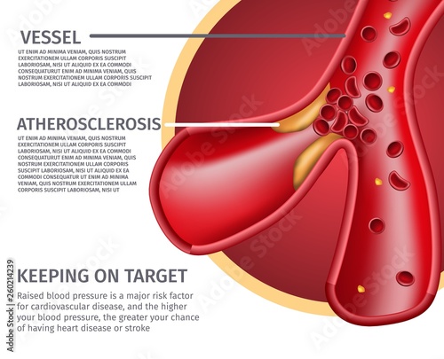 Realistic Atherosclerotic Vessels Anatomy Banner