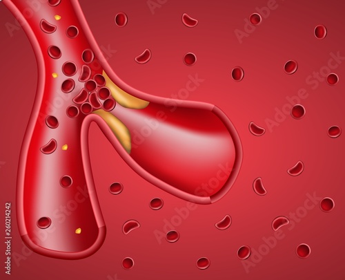 Realistic Vessel and Atherosclerotic Plaque Banner