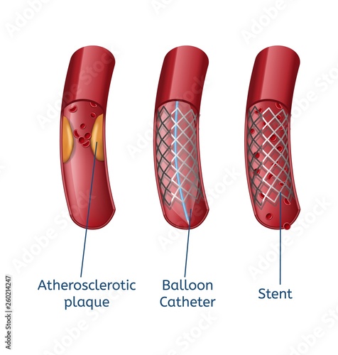 Elimination Atherosclerosis Realistic Presentation