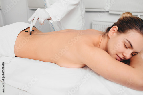 Hirudotherapy procedure. The doctor holds the leech, close-up, applying leech it to the patient's skin. photo