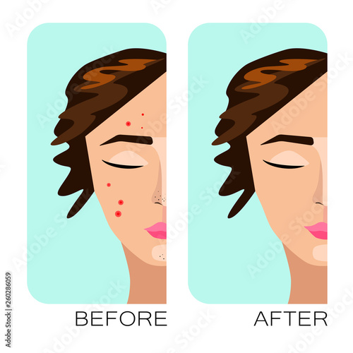Woman face with acne problems, pimples, blemish skin, hormones, pollution. Young white girl character personal care. Before after concept image. Cosmetics Advertising. Vector beauty color illustration