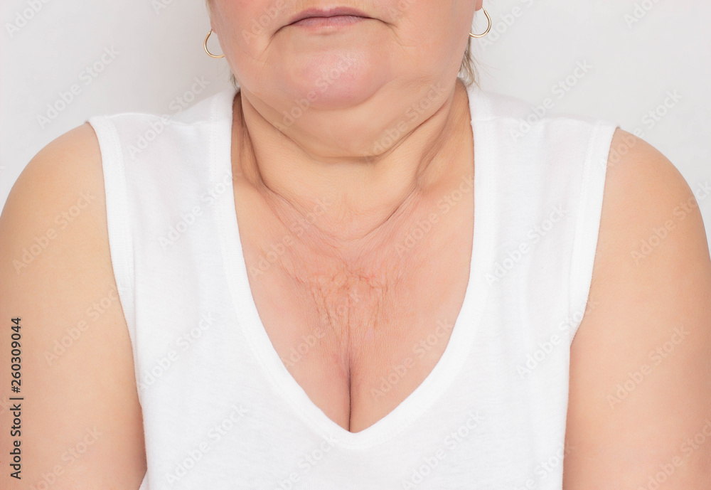 The problematic place for a woman is dry and wrinkled skin in the zone of decollete for a woman, white background, cosmetology, pigmentation The problematic place for a woman is dry and wrinkled skin in the zone of decollete for a woman, white background, cosmetology, pigmentation