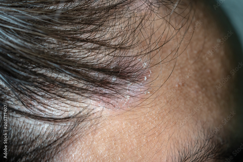 custom made wallpaper toronto digitalSkin diseases, on the scalp ,Woman with dandruff in her dark hair