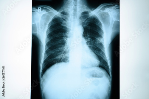 Chest x-ray image.Medical concept.