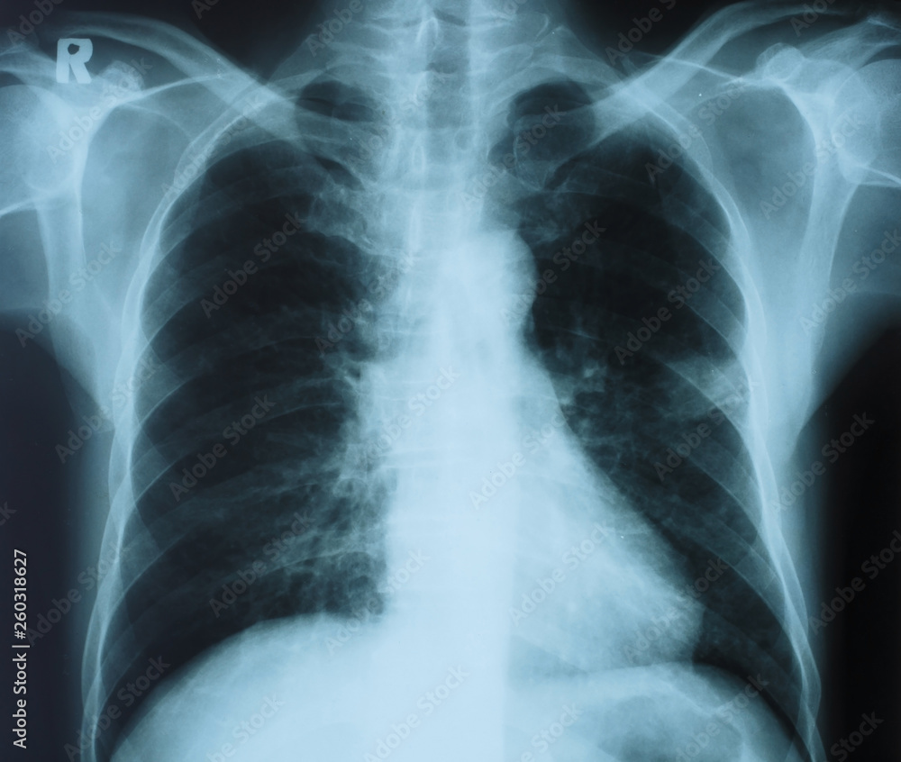 X-ray image film of human chest for a medical diagnosis on the light box X-ray image film of human chest for a medical diagnosis on the light box