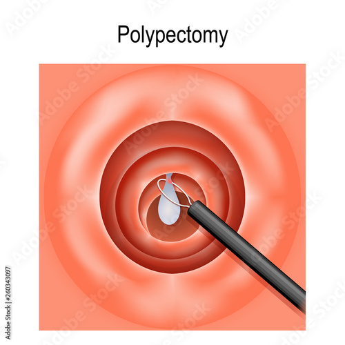 Colorectal polyp and Polypectomy