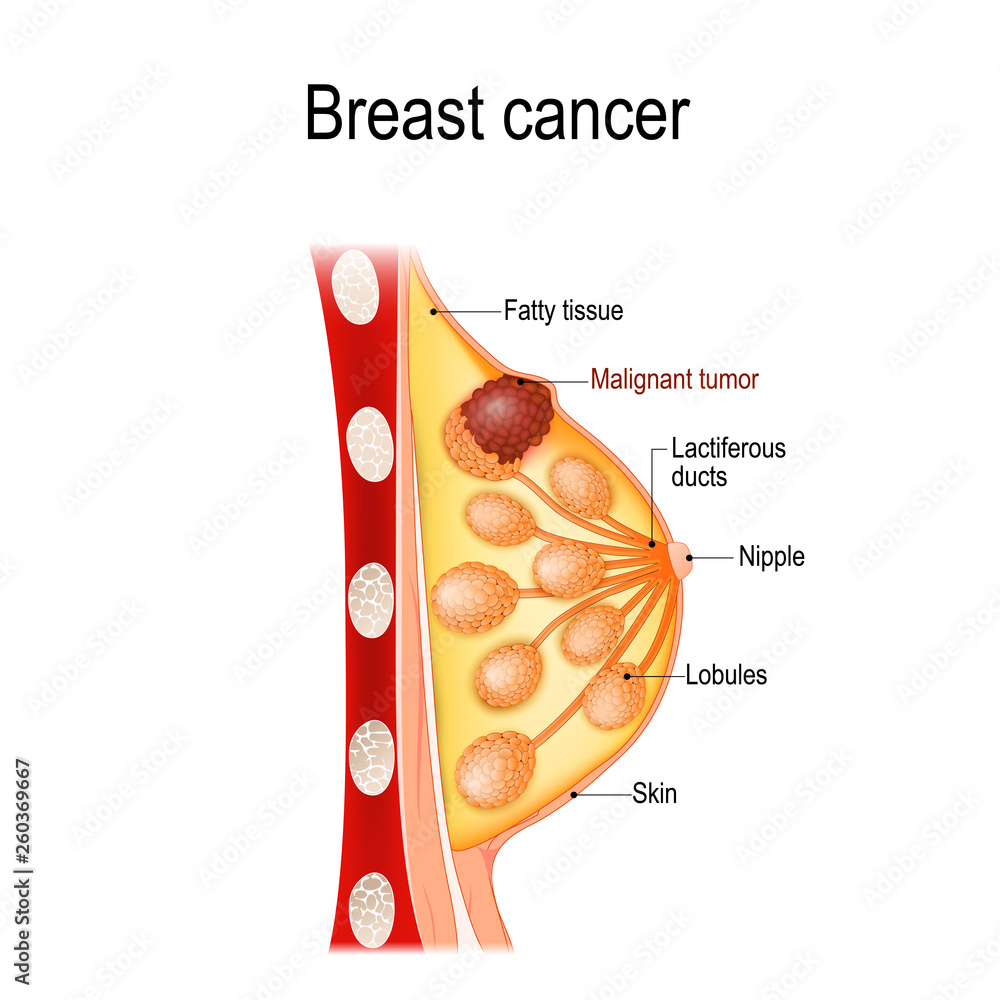 Breast cancer. Crosssection of the mammary gland with tumor. Stock