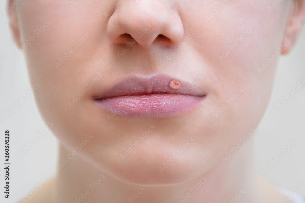 Obraz premium Face of a caucasian girl close-up Face, caucasian, girl, closeup, herpes, lips, woman,