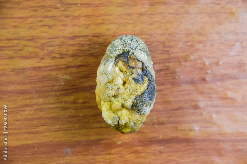 Large gallstone, Gall bladder stone. The result of gallstones Large gallstone, Gall bladder stone. The result of gallstones