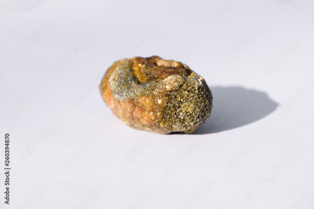 Stone of gallbladder. The result of gallstones. A calculus of heterogeneous composition. Stone of gallbladder. The result of gallstones. A calculus of heterogeneous composition.