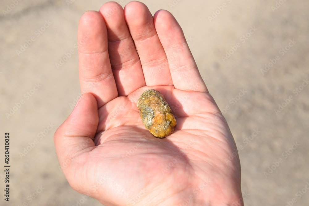 Gallstone in hand, Gall bladder stone. result of gallstones. Calculus of heterogeneous composition Gallstone in hand, Gall bladder stone. result of gallstones. Calculus of heterogeneous composition