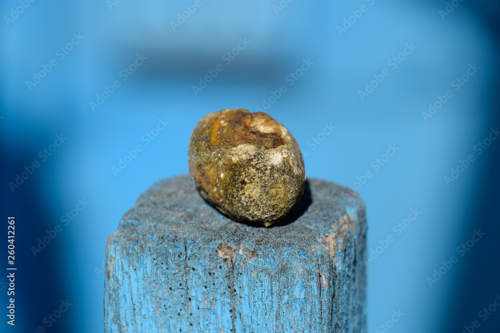 Gall bladder stone. Calculus of heterogeneous composition Gall bladder stone. Calculus of heterogeneous composition
